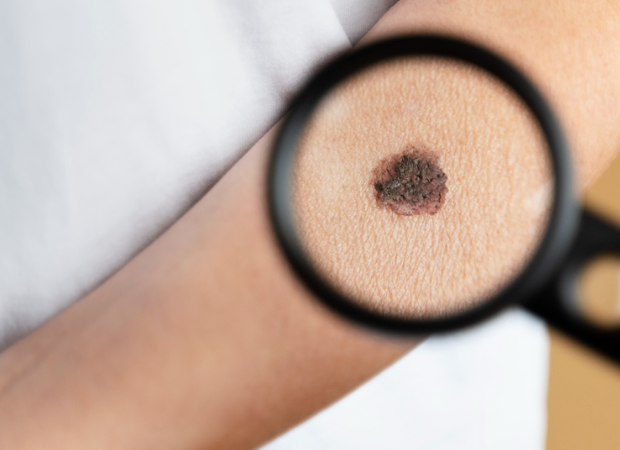 Skin Cancer Reconstructive Surgery