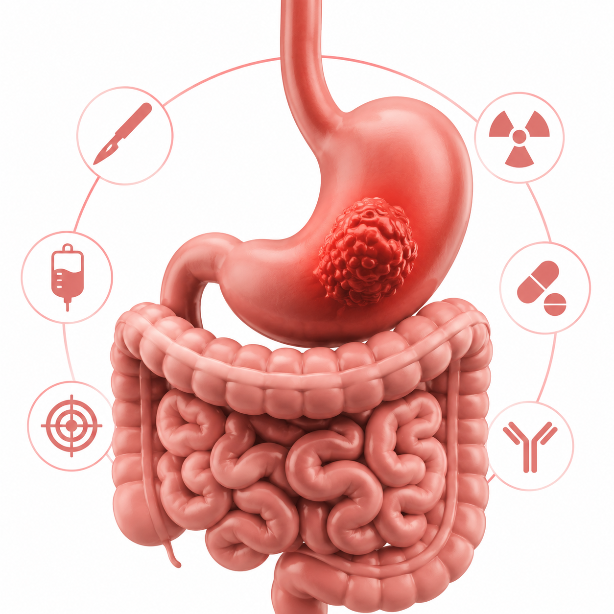 What Is Stomach Cancer