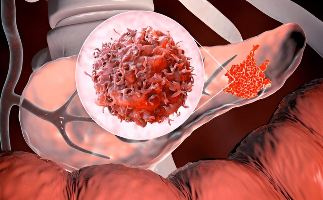 Endocrine cancer